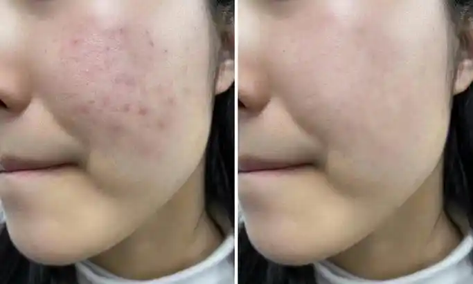 【真人实测骆王宇刷酸】脸上疯狂冒油,痘痘黑头一大堆,皮肤粗糙被轻松