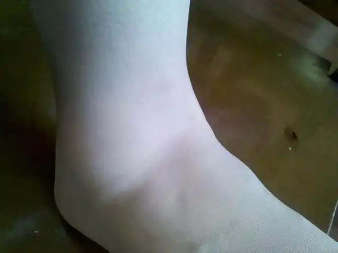 穿高跟鞋崴脚很肿需要去拍片吗