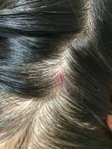 大概一个月前,头皮上起了一个指甲盖大小的包,摸着有些硬,弄破会有