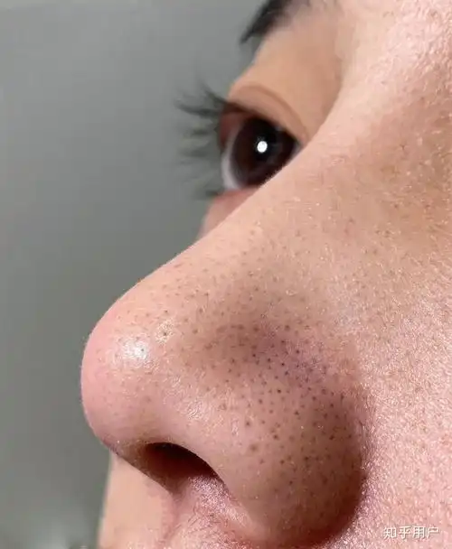 如何清理黑头收缩毛孔(彻底清除黑头缩毛孔的方法)