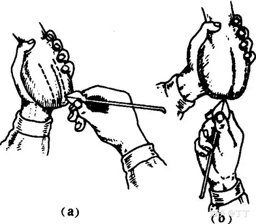 手术治疗是各种类型鞘膜积液治疗的主要方法.