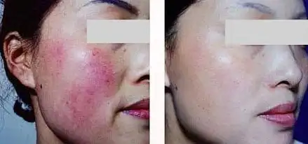 激光去红血丝前后的效果对比图