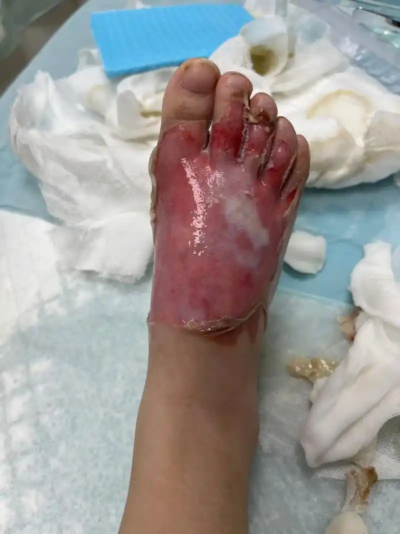 熊孩子4岁又经历一次烫伤,小班生活看来只能 - 抖音