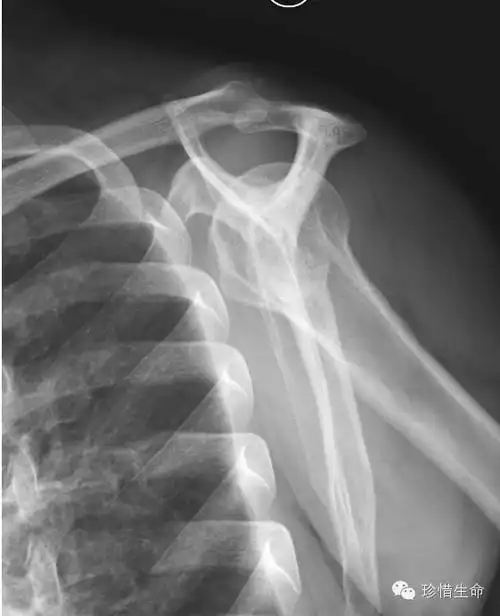 肩关节x线检查体位大全