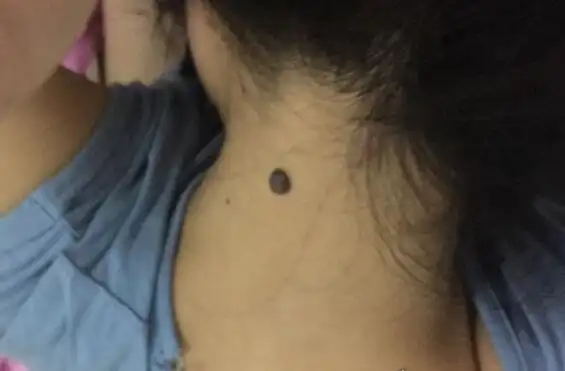 脖子后面有痣代表什么详解男人和女人脖子后面痣的意思