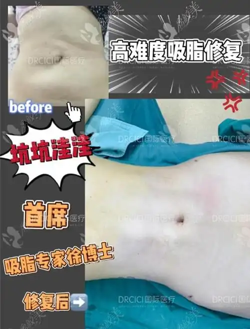 吸脂失败会怎样南京米嘉徐鹤然的威塑吸脂修复靠谱吗