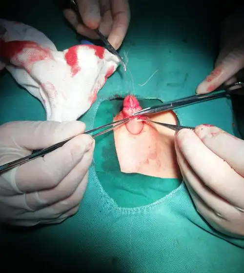 经包皮入路联合阴茎阴囊角重建隐匿阴茎矫形术