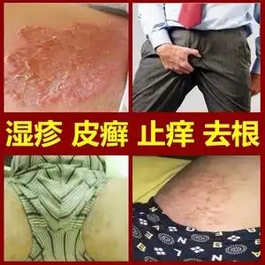 湿疹止痒去根成人阴囊抑菌乳膏私处皮肤瘙痒专用治疗癣藓外用药膏