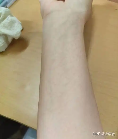 胳膊上有红色的类似于血管的东西?