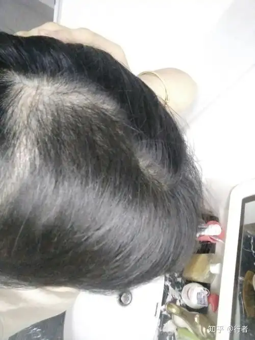 拔毛癖的自救之路