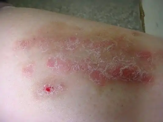 皮肤病拍图识别