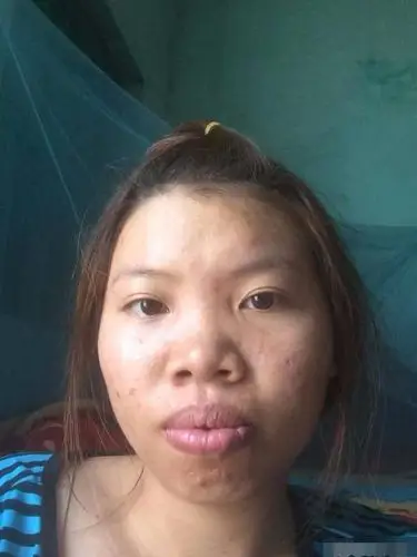 女子因长太丑无人敢娶!狠心花几十万整容后,结果令人傻眼了