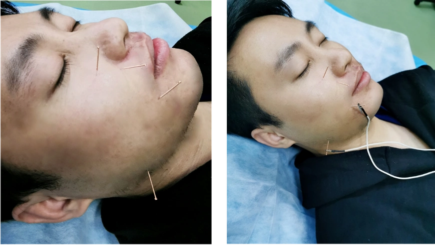 面瘫的康复治疗