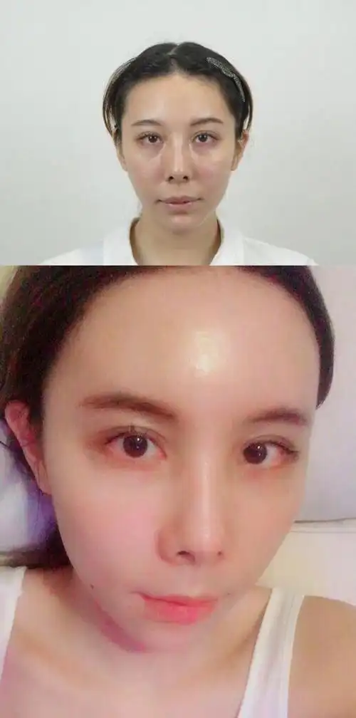 脂肪填充脸10天的图片