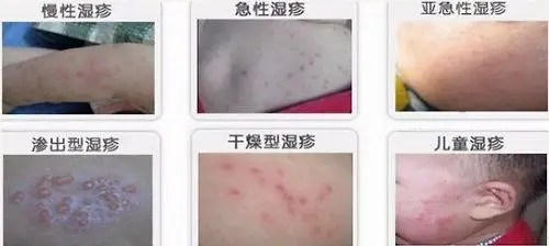 贵阳肤康皮肤病医院家中预防医治湿疹方法四点是基础两点是食疗