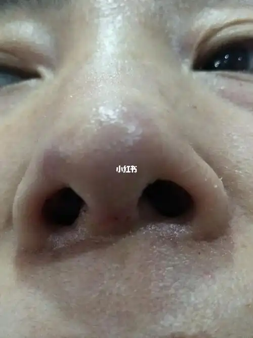 今天拆线的第二天,鼻头为什么会发乌.之前没有发乌的现像.