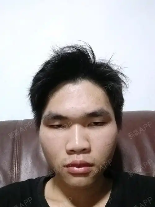 这是属于上睑下垂还是眼提肌无力?