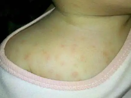 湿疹病症呈现的相应原因