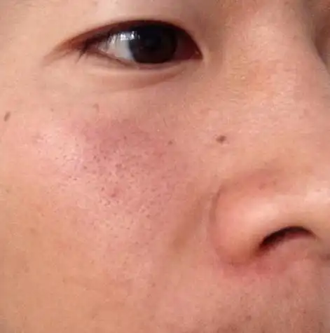 脸部毛孔大怎么办 女生脸部毛孔大怎么办 - 许许生活网