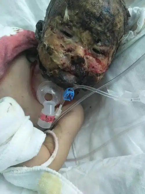 吴忠市一家亲爱心协会公益捐助系列活动之海原烧伤儿童李雅琪