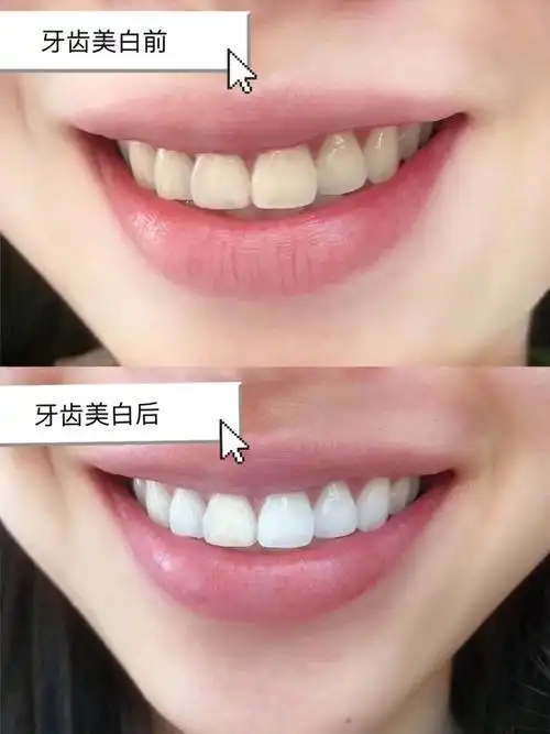 牙齿比较黄,做了美白,效果还可以,白的颜色自然,没有特别白,但是比之