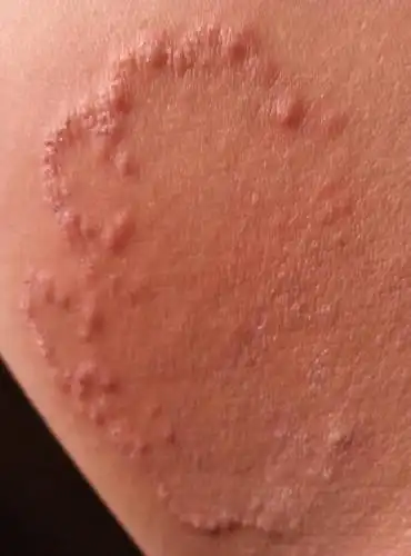 大夫给看看,大腿内侧长的,痒的很,皮炎平效果不打大.