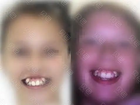 虎牙不矫正有危害吗?矫正的话需要多久!