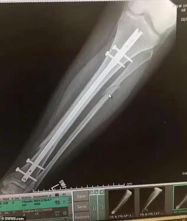 女子婚前摔断腿机智姐姐将腿复位获评英国最佳伴娘