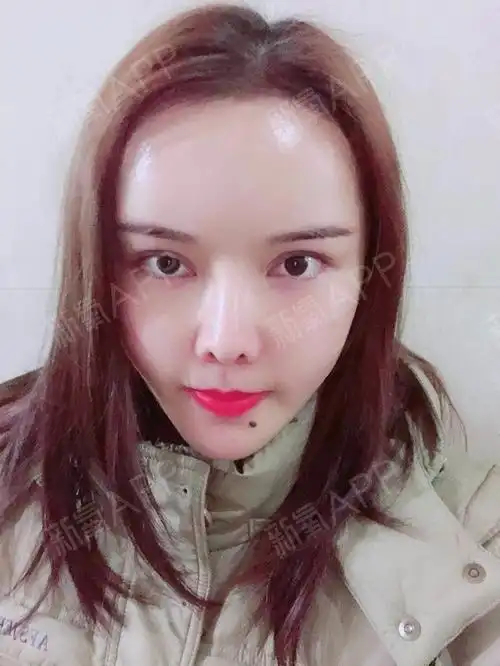 又又_呦呦自体脂肪全脸填充第32天美丽日记