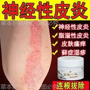 治疗神经性皮炎去根除外用顽固慢性过敏皮肤痒湿疹止痒牛皮癣药膏
