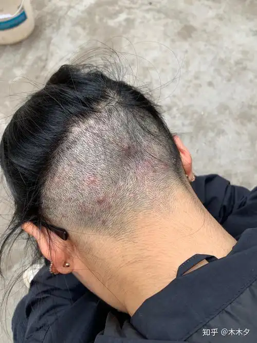 头皮上发毛囊炎该怎么办? - 知乎
