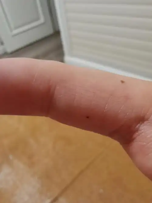 右手无名指,左手食指和中指,突然长出来四颗萌萌痣,不知道是什么情况