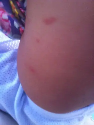 宝宝从北京回老家身上起了好多像水泡一样的红疙瘩!是不是水土不服呀?