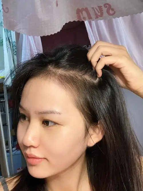 发际线效果分享!