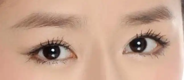 合肥多少钱可以做双眼皮