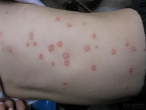 看图识病----------银屑病 - 皮肤及性传播疾病讨论版 - 爱爱医医学