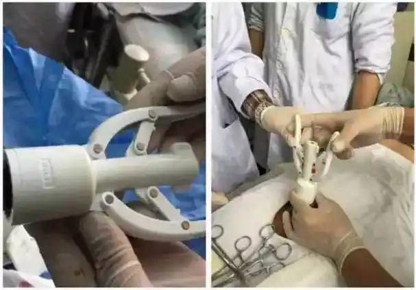 微创包皮环切吻合器手术