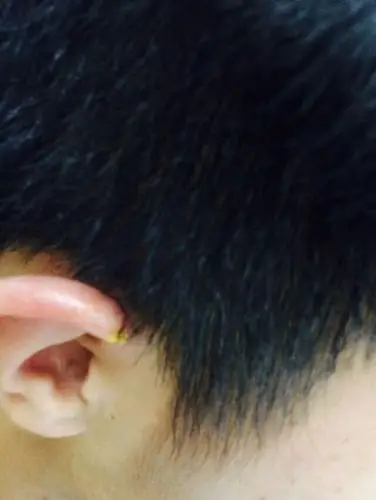 耳轮上方红肿,瘙痒,而且还流出黄色液体.