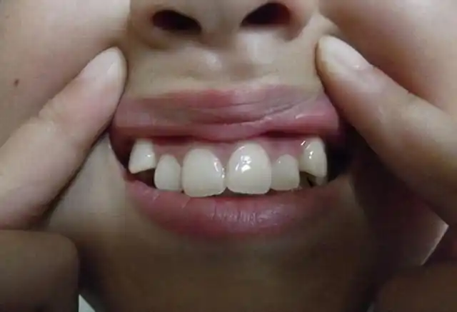 从小啃指甲的娃长大后是什么模样大夫坦言逃不过这2种结局