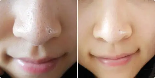 收缩毛孔-彩光嫩肤效果图,案例前后对比照片