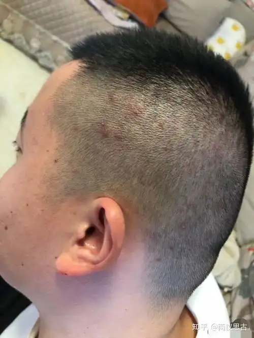 毛囊炎疙瘩要怎么才能消除呢