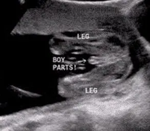 而三条线则是明显的女宝,如果没有看到明 显的三条线,就看两腿之间有