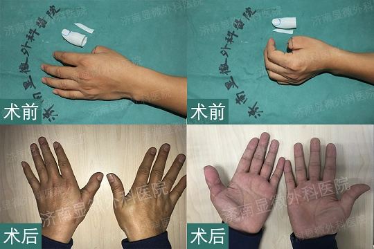 美国一男子丢失大拇指将脚趾移到手上重塑脚趾大拇指