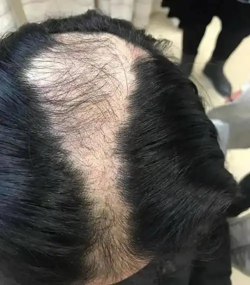 9岁女孩不断脱发变秃顶,原因查明是孩子自己拔的?父母后悔不已