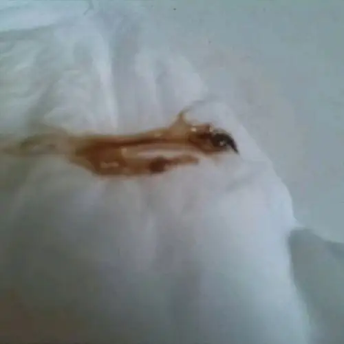 血性白带是什么原因导致的哪?它是_圈子-新氧美容整形