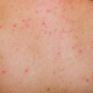 皮肤科医生做治疗,过敏性皮疹皮炎湿疹皮肤,皮肤疾病的女性患者过敏性