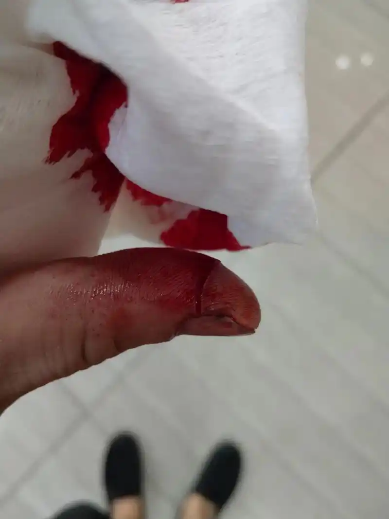 一不小心手受伤了,我没有怪刀子太锋利,而是责怪自己不小心,手 - 抖音