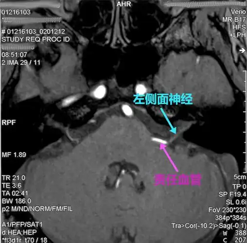 面肌痉挛_检查_治疗方法_治疗方式 - 好大夫在线