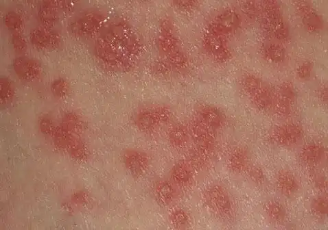 病毒性皮肤过敏图片