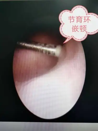 更年期—别错过取环的最佳时机